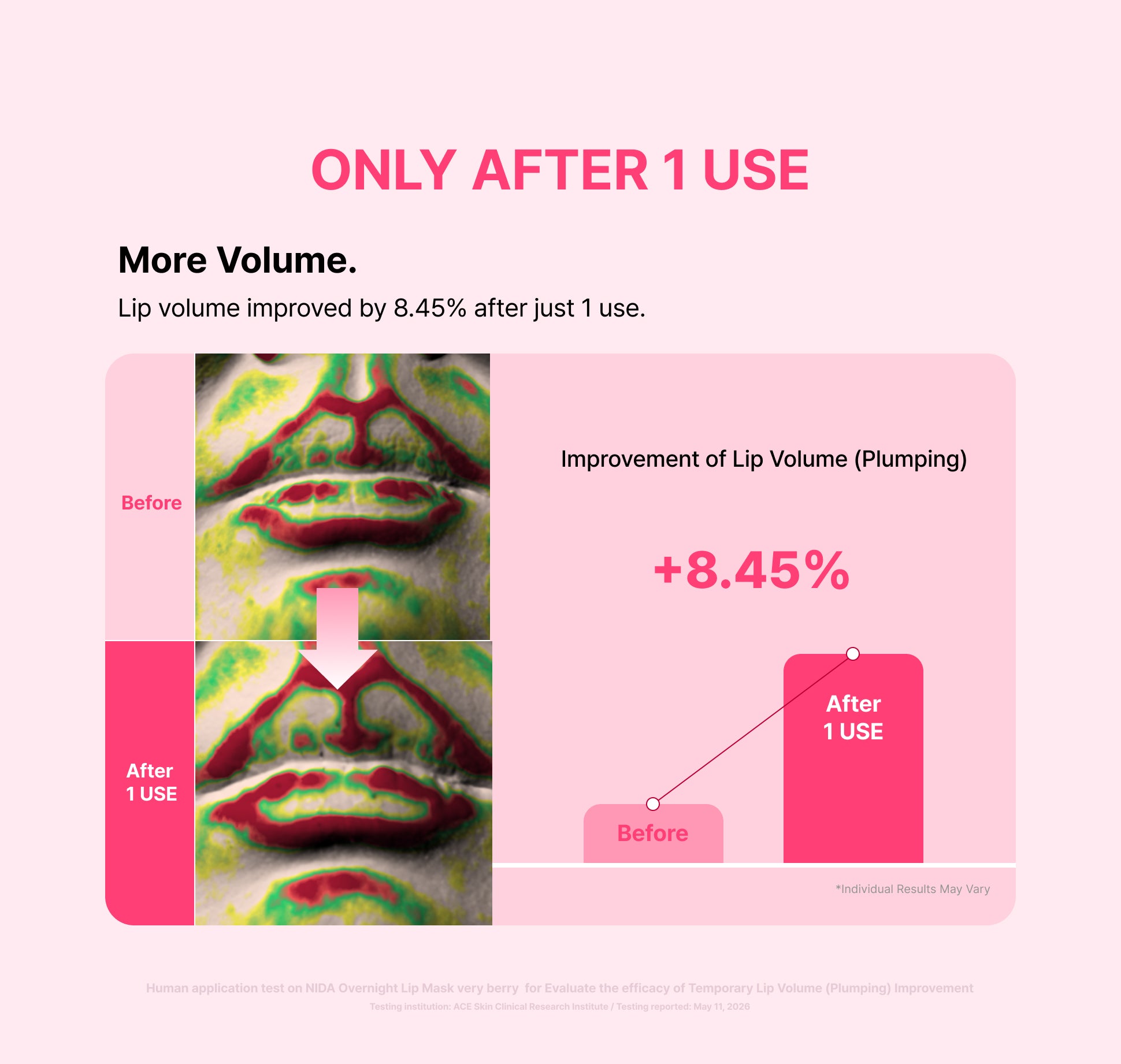 Scansioni a colori del volume delle labbra prima e dopo 1 utilizzo